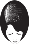 Beginning Hair Loss | BeautyTrends