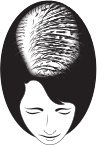 Mid/Progressive Hair Loss | BeautyTrends