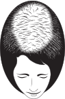 Advanced Hair Loss | BeautyTrends